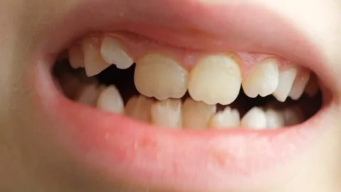 Child with crowded teeth. Stock Footage 330952018