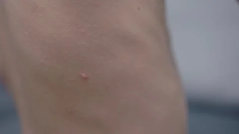 Child is down with chickenpox lying on couch body in close-up. Boy is sick by Stock Footage 290241384