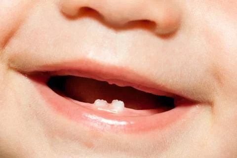 Child first two milk teeth close up Stock Photos