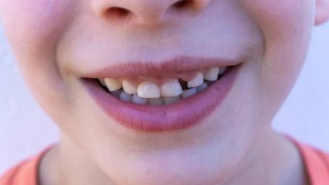 Child happily smiling, showing missing front milk teeth Stock Photos