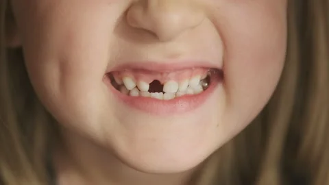 Child has lost milk teeth. Replacement of permanent changing teeth Stock Footage 160121659