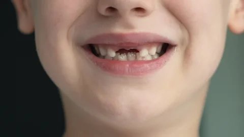 The child has lost two milk teeth. Replacement of permanent replacement teeth Stock Footage 284877664