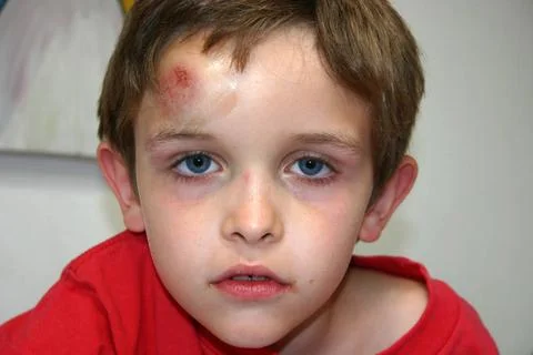  Child with hematoma 8-9 year old boy with a big bump on the forehead on w... Stock Photos