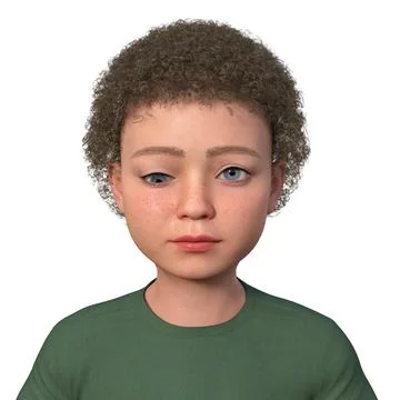 A child with hypotropia, 3D illustration イラスト素材