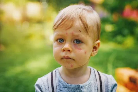 Child with insect bites Stock Photos