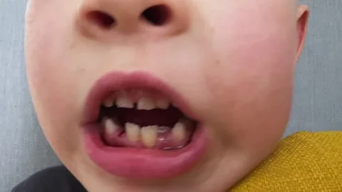 Child Mouth with Crowded Teeth Closeup Concept of Orthodontic Problem Stock Footage 336466946