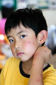 Child With Multiple Mosquito Bites Stock Photos
