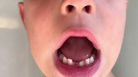 Child with opens mouth, missing front tooth, plaque, tooth grows unevenly Stock Footage 346153385