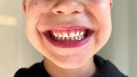 Child with primary teeth smiles widely, visible enamel changes, shifted midline Stock Footage 346153324
