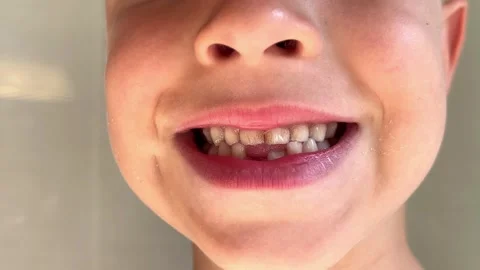 Child with primary teeth smiles widely, missing front tooth and visible plaque Stock Footage 346153414