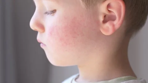 Child profile with red cheeks and rash showing allergy, atopic dermatitis Stock Footage 330973113