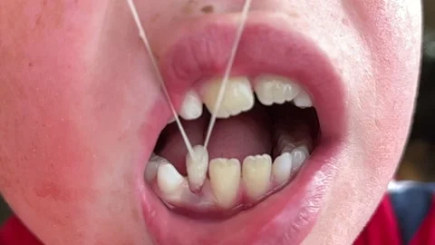 Child pulls tooth out with string (slow motion) Stock Footage