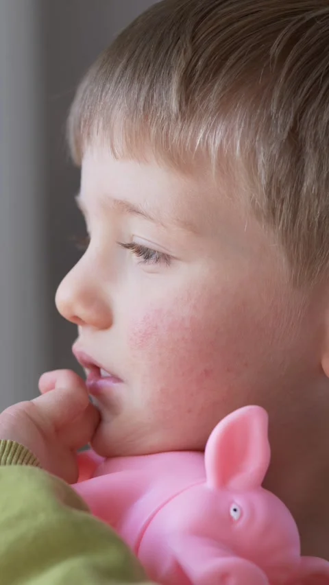 Child with red cheeks and skin rash holding toy illustrating pediatric Stock Footage 330973474