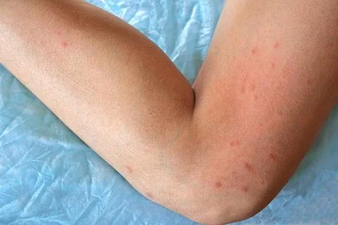 Child scratch body sensitive itchy skin. Bodily rash. Teen allergy closeup Stock Photos