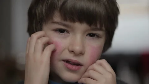Child Scratching Red Rash on Face. Boy Scratches Atopic Skin. Dermatitis, D.. Stock Footage 311064234