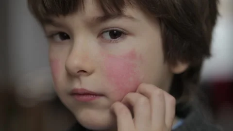 Child Scratching Red Rash on Face. Boy Scratches Atopic Skin. Dermatitis, D.. Video stock 311414611