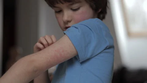 Child Scratching Red Rash on Hand. Boy Scratches Atopic Skin. Dermatitis, D.. 스톡 동영상 311412684