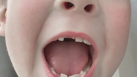 Child showing teeth changing Stock Footage 320948870
