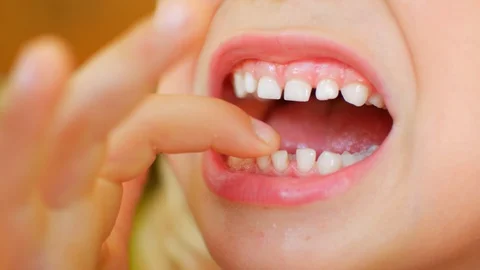 The child shows his first staggering tooth. Finger loosens baby's tooth. Video stock 128973545