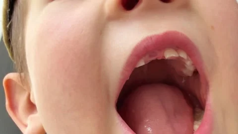 Child Shows Missing Baby Teeth Closeup Concept of Orthodontic Care and Growth Stock Footage 336466926