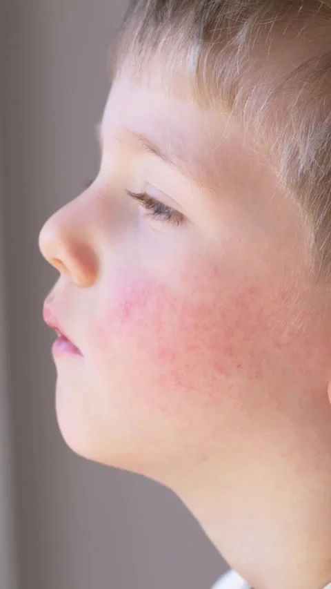 Child side view showing skin redness and irritation, medical concept of allergy Stock Footage 330973210