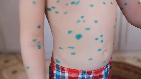 The child is a small boy with chicken pox. The mother uses an antiseptic Stock-Footage 90496548