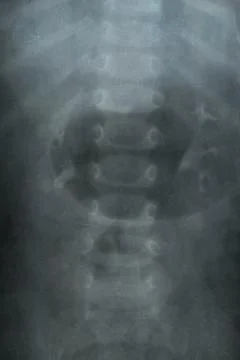 Child spine x-rays for diagnostics, image analysis, back problem detection Stock Illustration