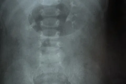 Child spine x-rays for diagnostics, image analysis, back problem detection Illustrazione stock