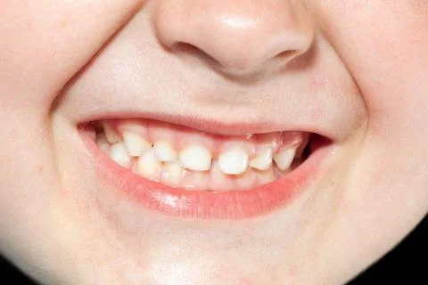 Child teeth close up Stock Photos