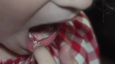 Child touching loose and bleeding baby tooth with finger. Video stock 332241667
