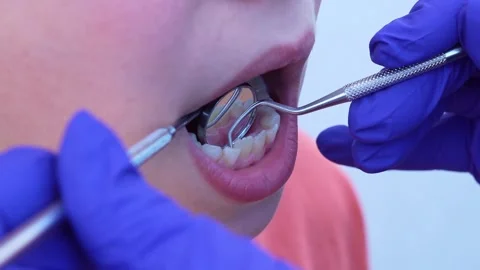 Child undergoing a dental check up with a mirror and probe by a dentist Stock Footage 332777366