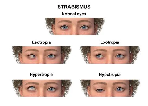 A child with various strabismus types, 3D illustration イラスト素材
