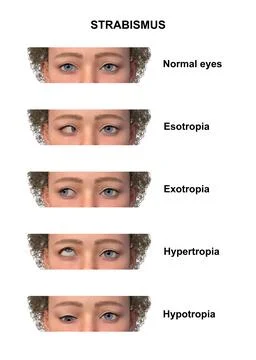 A child with various strabismus types, 3D illustration Stock Illustration