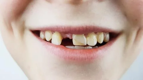 A child without a front tooth is smiling. dental examination dental treatment Stock Photos