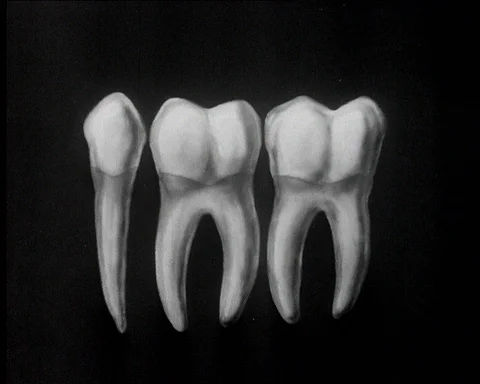 Children's teeth, animated illustration of the spread of tooth decay, UK 1945 Video stock 146086996