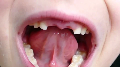 A child's front two primary teeth have fallen out at the age of losing prim.. 動画素材 258020036