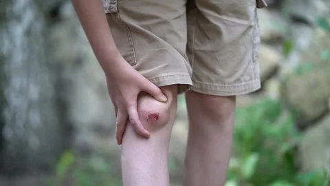 Child's knee with visible sore and wound. Stock Footage 342196096