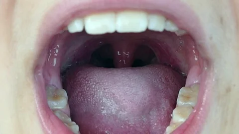 a child's tonsils mouth inside and tonsi... | Stock Video | Pond5