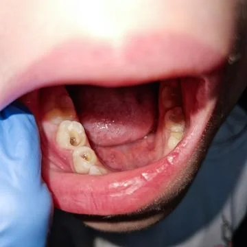 Child's treated teeth after root canal cleaning Stock Photos