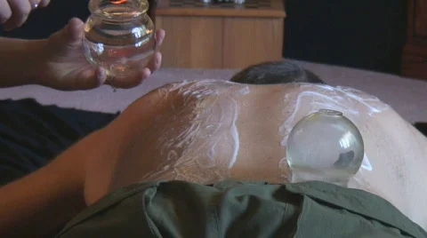 Chinese firecups are applied to a man's back Stock Footage 135155