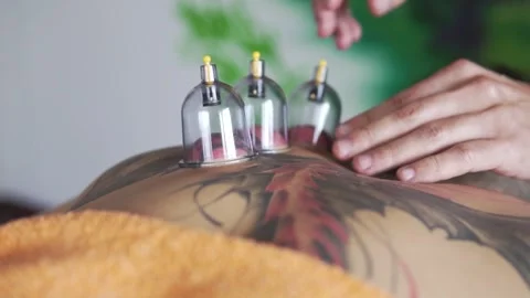 Chiropractor suction cups hands Stock Footage 246790945