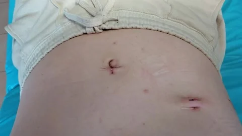 Cholecystectomy 1 Stock Footage 327478179