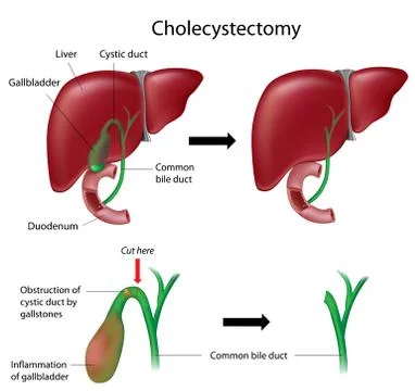 Cholecystectomy gallbladder removal surgery Stock Illustration