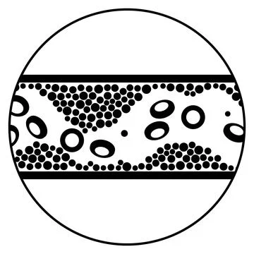 Cholesterol and atherosclerosis Stock Illustration
