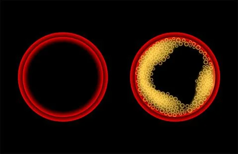 Cholesterol and atherosclerosis Illustrazione stock