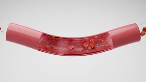 Cholesterol and embolic stroke Video stock 251931525
