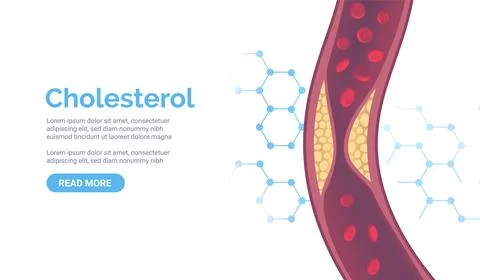 Cholesterol artery thrombosis micro vascular desease. Arteriosclerosis blood Stock Illustration
