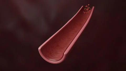 Cholesterol collecting in artery Stock Footage 251915357