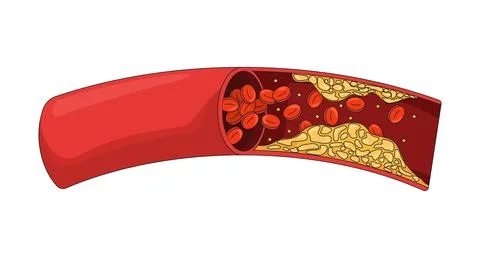 Cholesterol plaque obstructing blood flow 2D vector illustration Stock Illustration