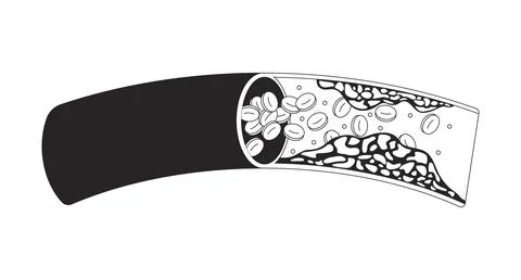 Cholesterol plaque obstructing blood flow outline illustration Stock Illustration